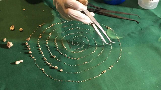 Extraen 526 dientes de la mandíbula de un niño Extraen 526 dientes de la mandíbula de un niño