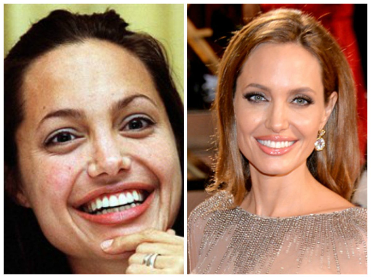 Анджелина Джоли виниры