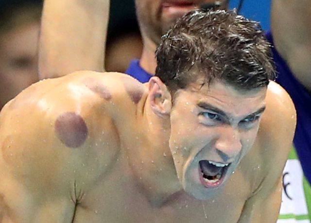 Esta es la razón de las tremendas manchas de Michael Phelps