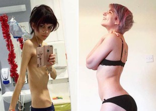 El antes y después de chicas que sufrieron anorexia