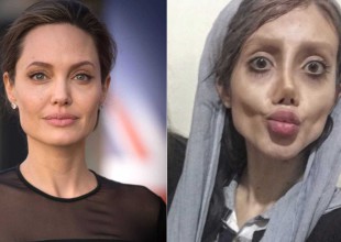 Así lucía la chica que se operó para parecerse a Angelina Jolie