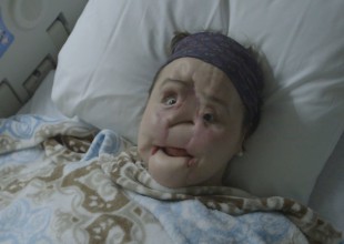 Intentó quitarse la vida y ahora es la persona más joven con transplante de rostro en EEUU