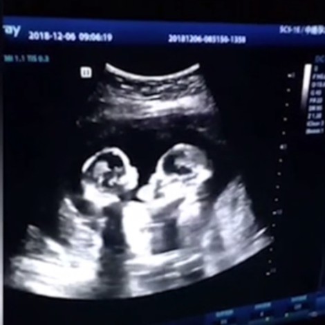Ultrasonido muestra la pelea de dos gemelas en el útero de su madre