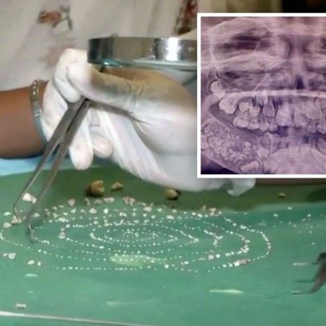 Extraen más de 500 dientes de niño siete años en India