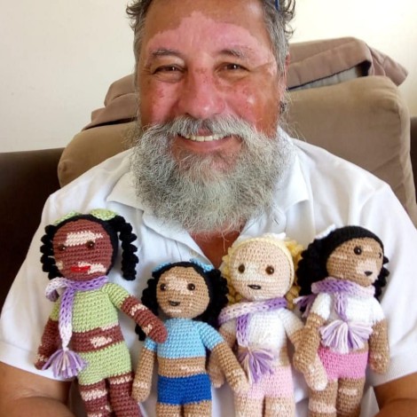Abuelito hace muñecas con vitiligo para su nieta