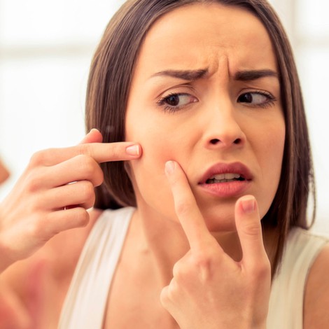 Consejos que te ayudarán a disminuir el acné
