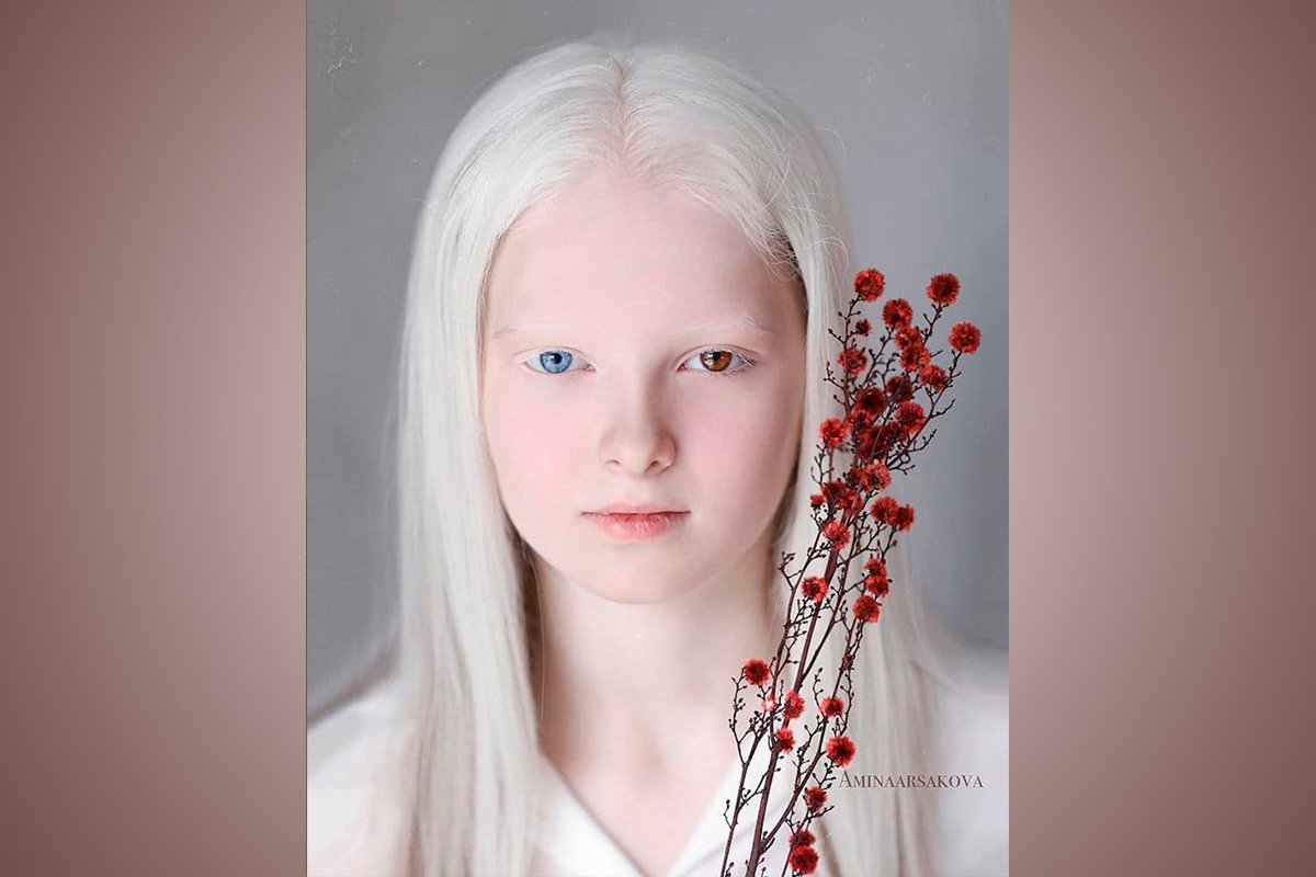 Albinismo y heterocromía en una niña que irradia belleza