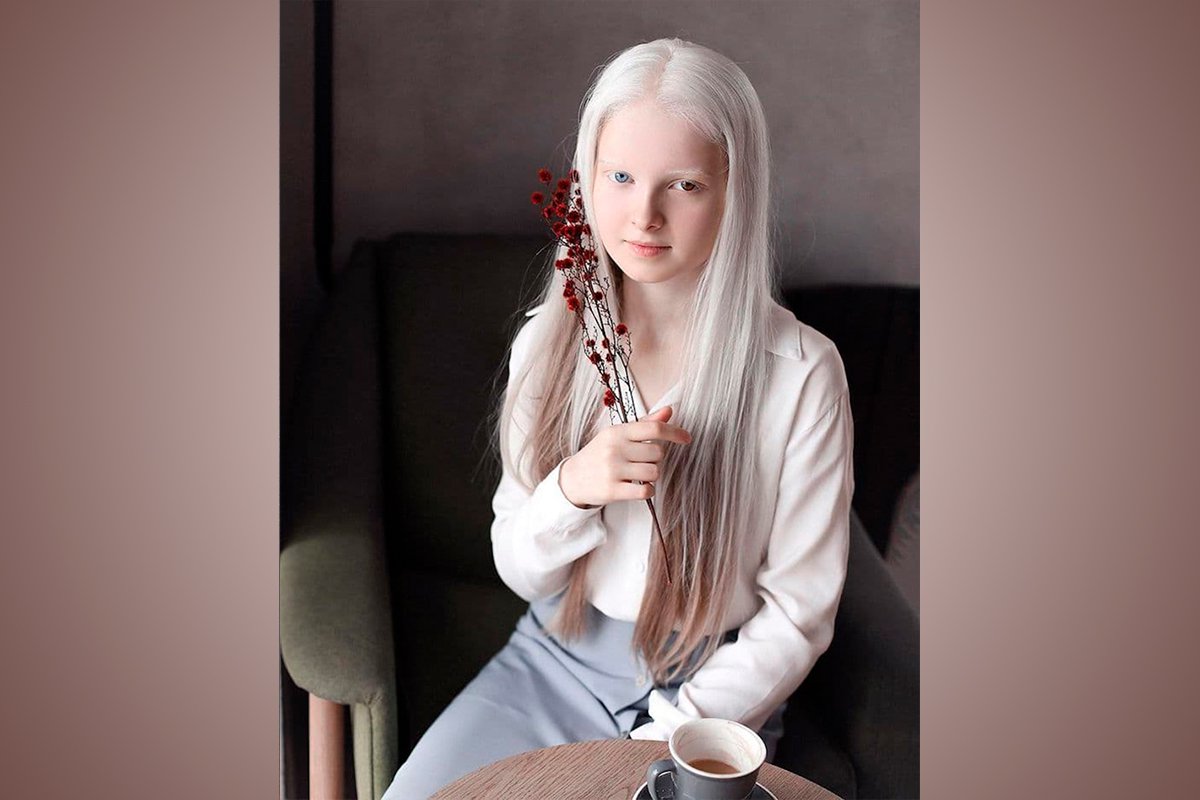 Albinismo y heterocromía en una niña que irradia belleza